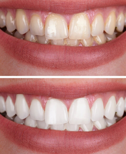 before and after photos of teeth whitening