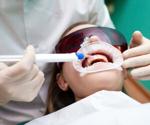 whitening gel being applied on patients teeth in the office