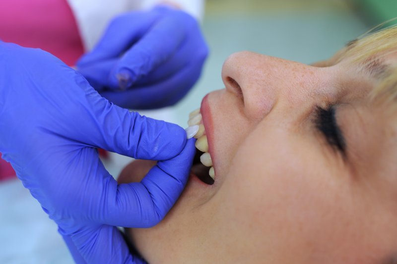 closeup of a dentist putting a new veneer on a patient