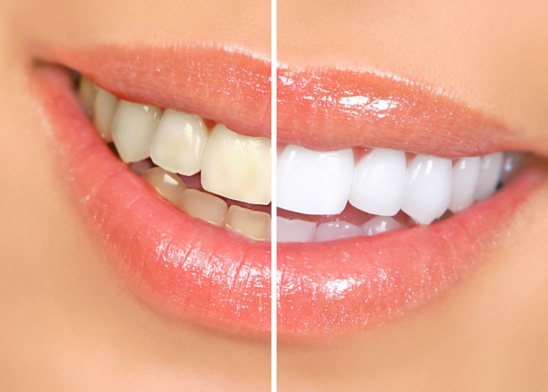 Before and after teeth whitening